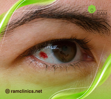 البقع-الحمراء-في-العين