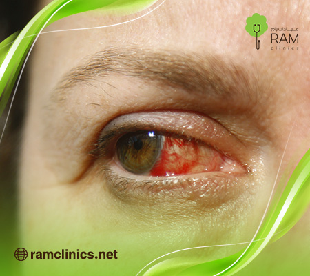 سبب-ظهور-بقعة-حمراء-في-العين