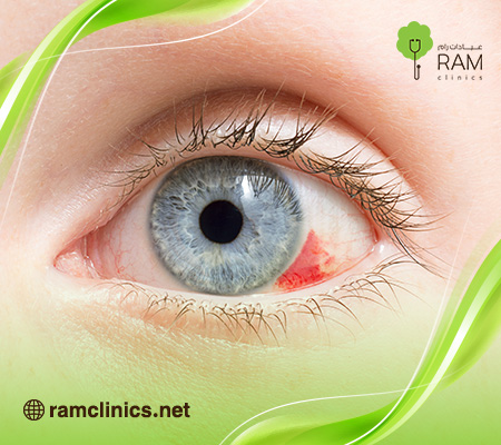  بقع-الدم-على-العين 