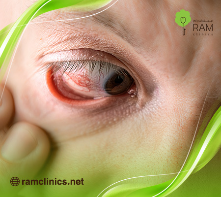 علاج-ظهور-نقطة-حمراء-في-بياض-العين