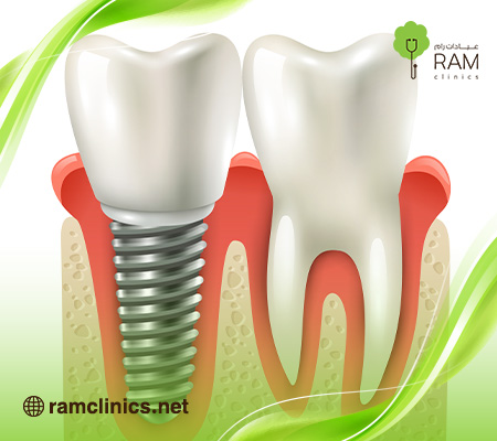 ما-هي-عملية-زراعة-الأسنان