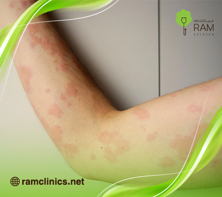 الحكة-في-الجسم