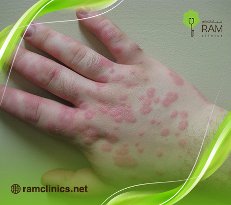 حكة-في-الجسم