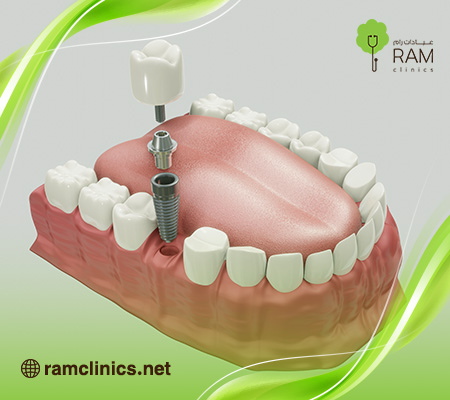 زراعة-الاسنان