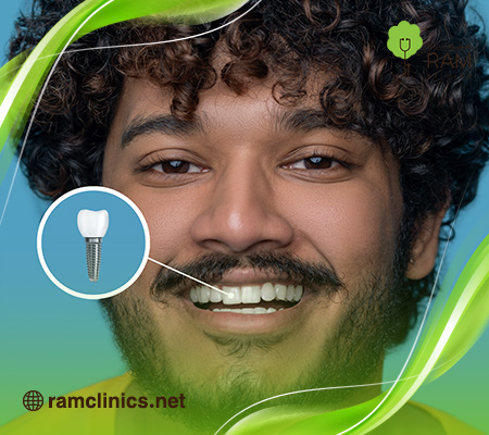 افضل-زراعة-اسنان