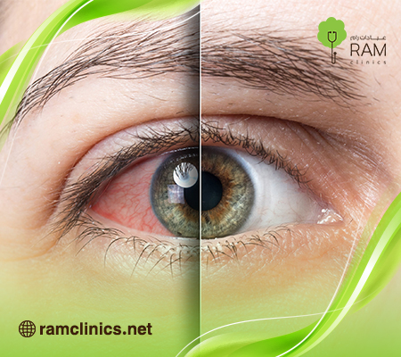 علامات-جفاف-العين