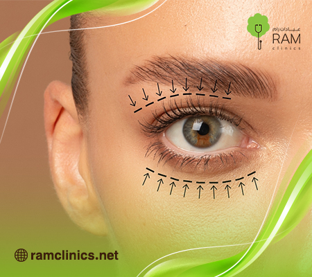 عملية-شد-الجفون