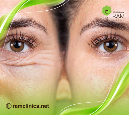 عملية-قص-الجفون-قبل-وبعد
