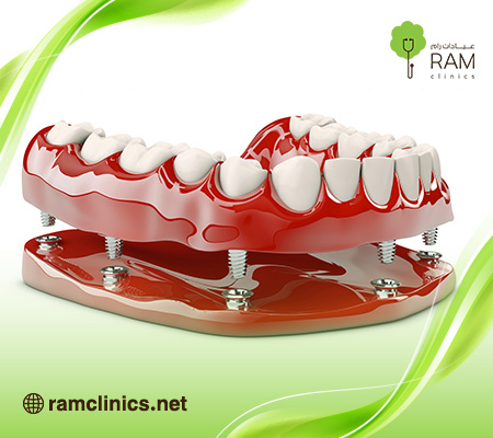 تركيبات-اسنان