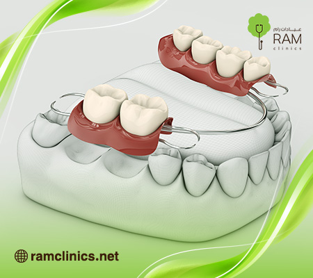 انواع-تركيبات-اسنان