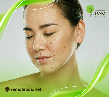 عملية-إزالة-الشامة