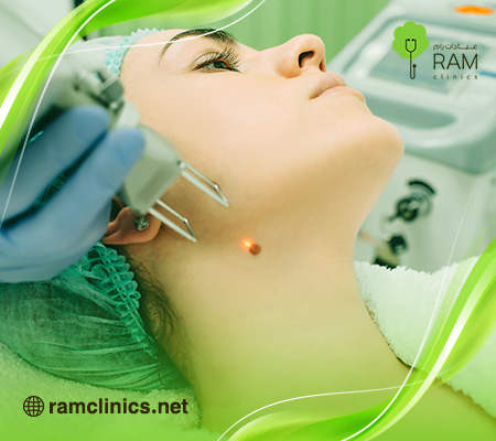 ازالة-الشامة-بالليزر