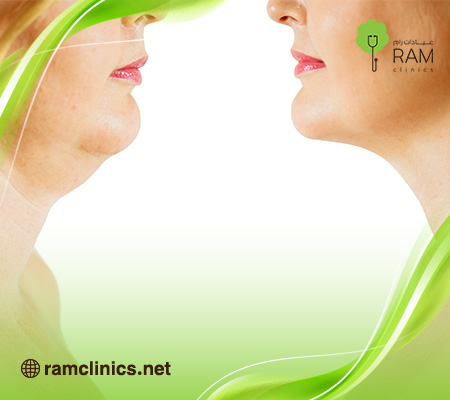 عملية-شفط-اللغلوغ