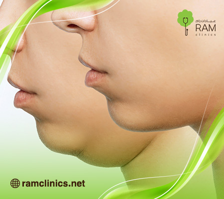 عملية-شفط-اللغلوغ