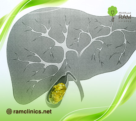 اعراض-حصى-المرارة