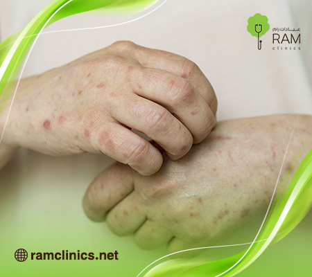 مرض-الزهري-للنساء