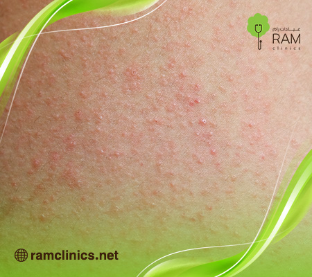 حبوب-صغيره-حمراء-بالجسم