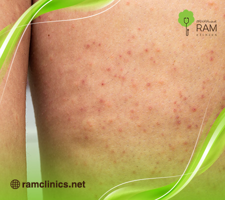 انتشار-حبوب-حمراء-في-الجسم