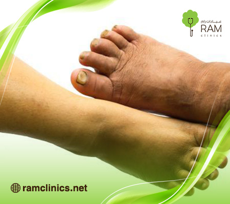 احتباس-السوائل-في-الجسم