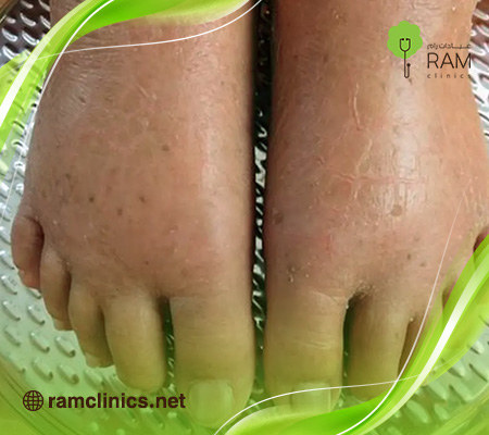 اعراض-احتباس-السوائل-في-الجسم