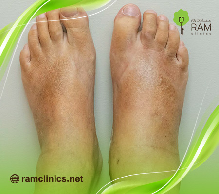 علاج-احتباس-السوائل-في-الجسم