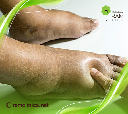 علاج-احتباس-السوائل-في-الجسم-بالأعشاب