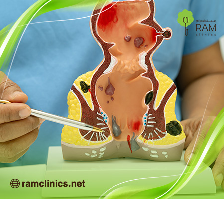 اسباب-البواسير-الخارجية