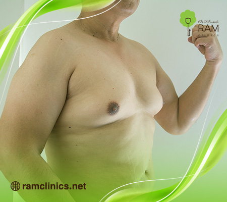 تصغير-الثدي-للرجال