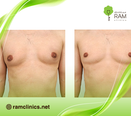 علاج-التثدي-عند-الرجال