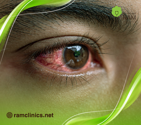 سبب-احمرار-العين