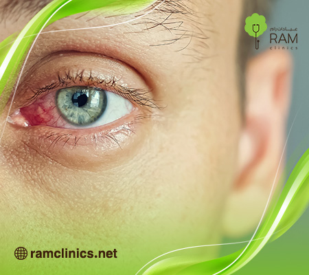 سبب-احمرار-العين-المفاجئ