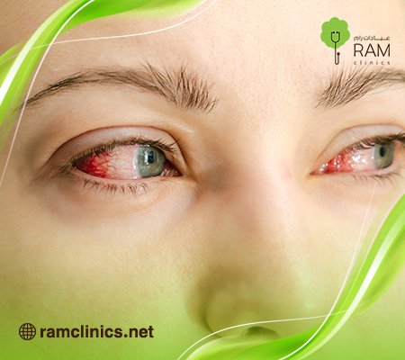 علاج-احمرار-العين-في-المنزل