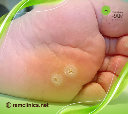 مسمار-القدم 