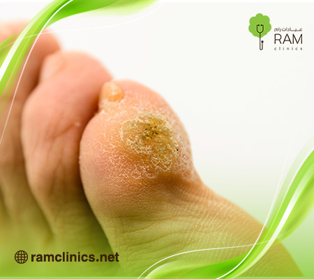 مسمار-القدم 