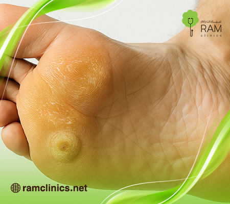 مسمار-القدم 