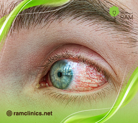 أعراض-العين-المتراكمة