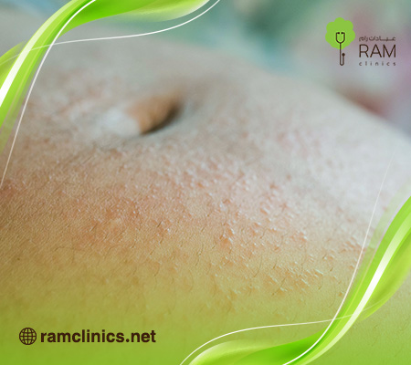 الحساسيه-للحامل