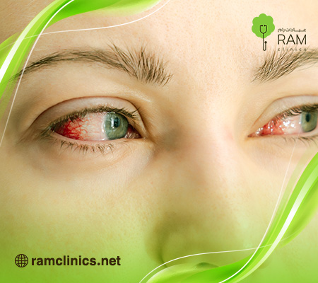 ما-هو-رمد-العين