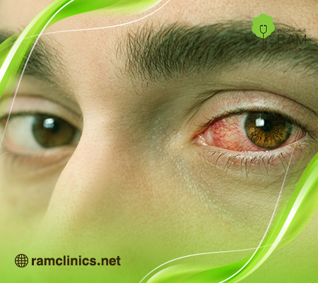 اعراض-رمد-العين