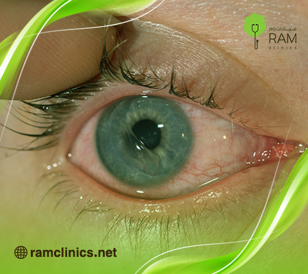 اسباب-خدش-القرنية