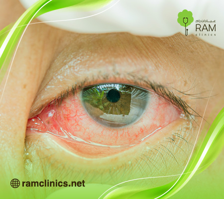 اعراض-خدش-القرنية