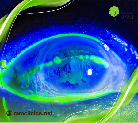 خدش-القرنية