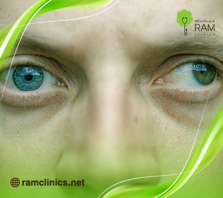 سبب-انحراف-العين