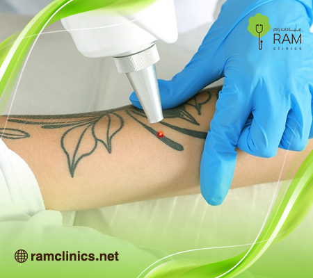 ازاله-التاتو