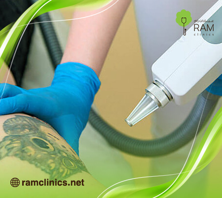 ازاله-التاتو-القديم