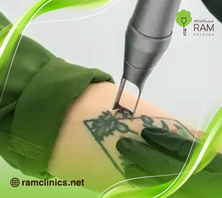 مركز-ازاله-التاتو-بالليزر