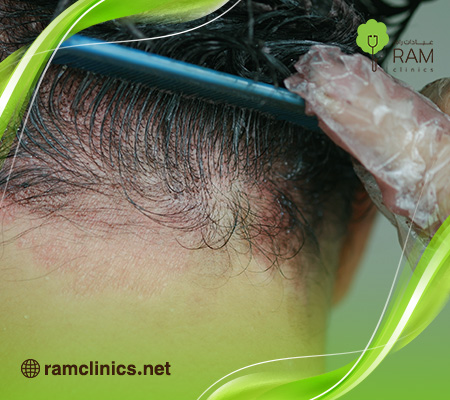 كيف-أزيل-الصبغه-من-الجلد