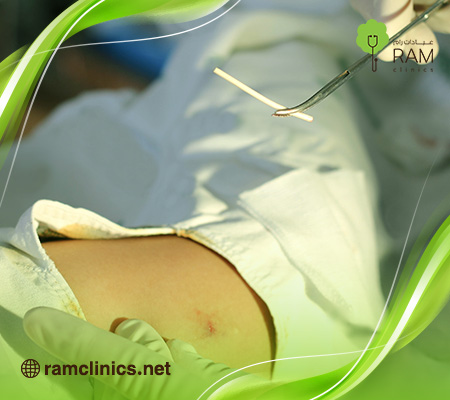 الأعراض-بعد-إزالة-شريحة-منع-الحمل