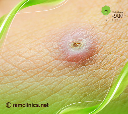 الفرق-بين-الدمامل-والخراج