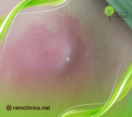 الفرق-بين-الدمامل-والخراج